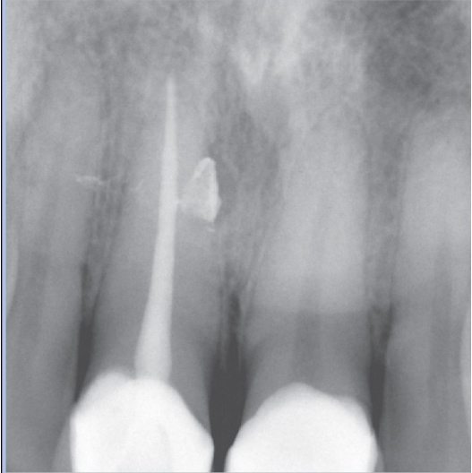 After Root Canal treatment