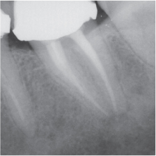 After Root Canal treatment