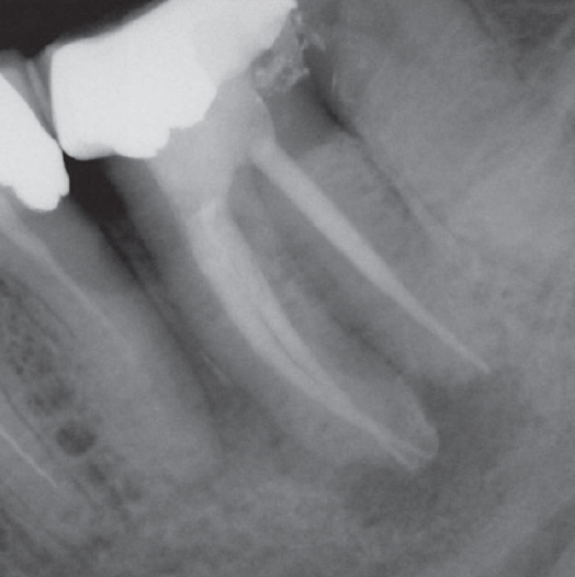 After Root Canal treatment