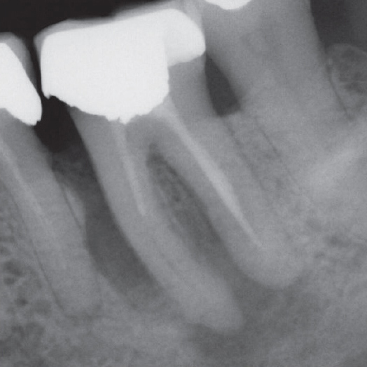 Before Root Canal treatment