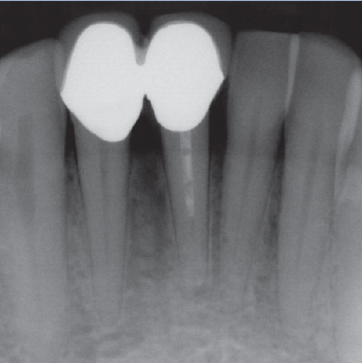 Before Root Canal treatment
