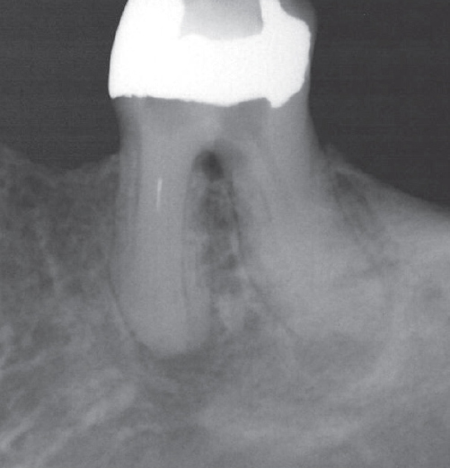 Before Root Canal treatment