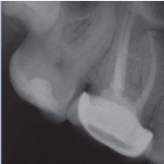 After Root Canal treatment