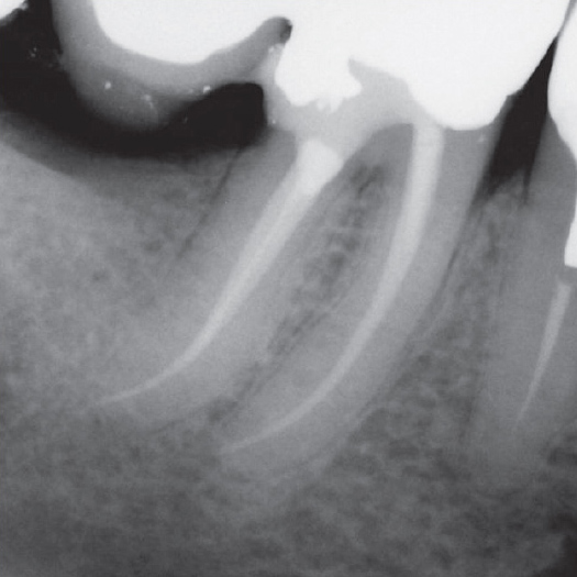 After Root Canal treatment