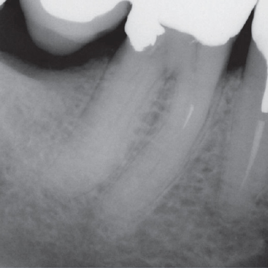 Before Root Canal treatment