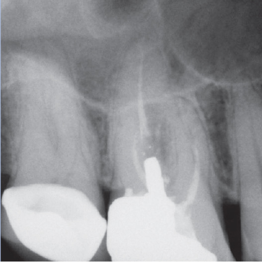 Before Root Canal treatment