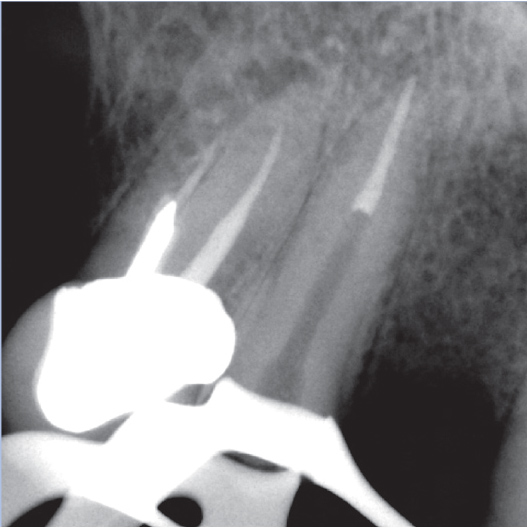 After Root Canal treatment