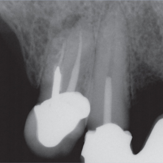 Before Root Canal treatment