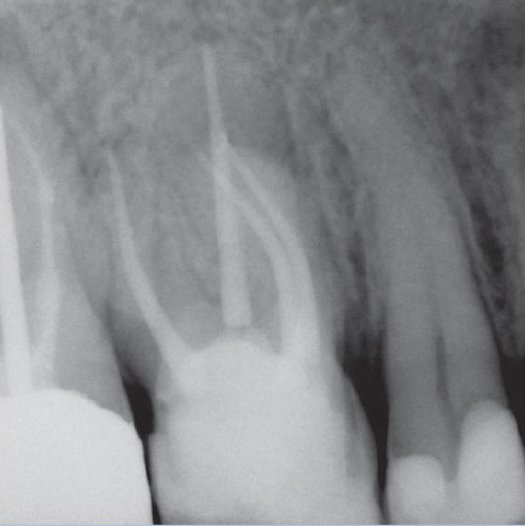 After Root Canal treatment