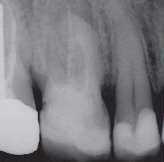 Before Root Canal treatment