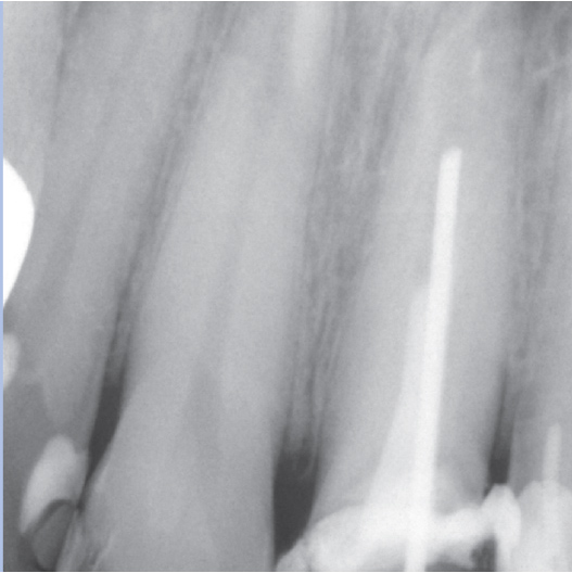 Before Root Canal treatment