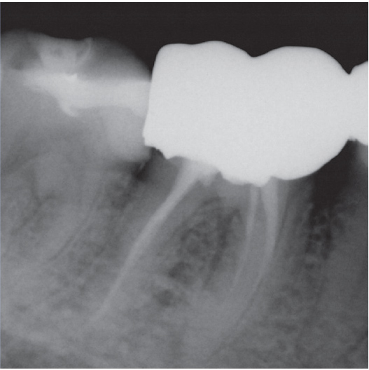 Before Root Canal treatment