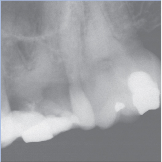Before Root Canal treatment