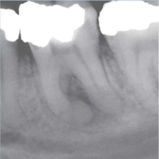 Before Root Canal treatment