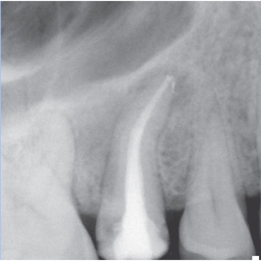 After Root Canal treatment