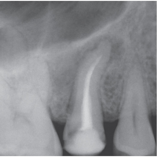 Before Root Canal treatment