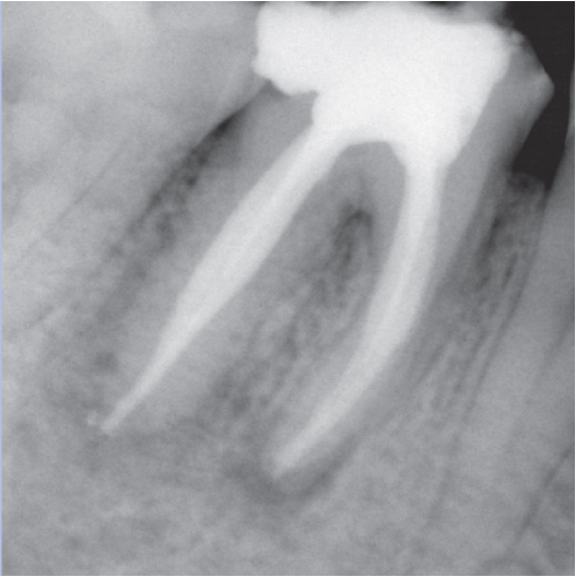 After Root Canal treatment