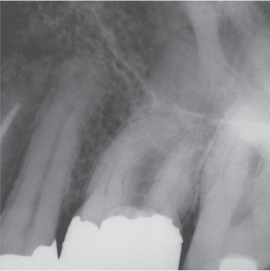 Before Root Canal treatment