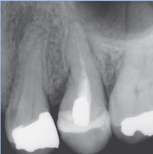 Before Root Canal treatment