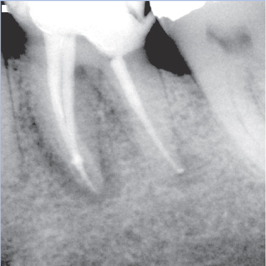 After Root Canal treatment