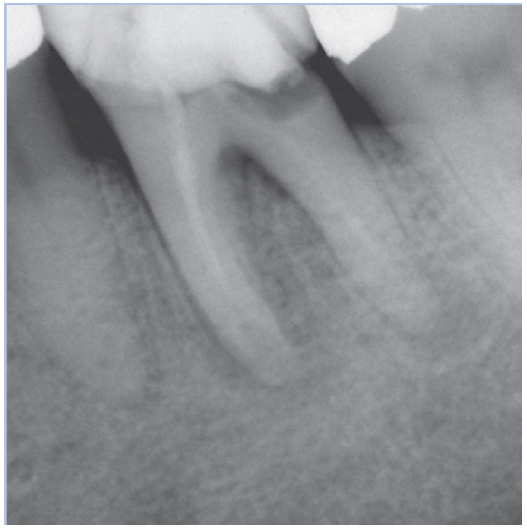 Before Root Canal treatment
