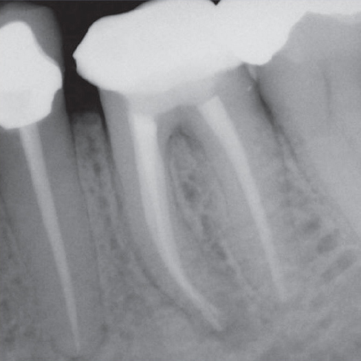 After Root Canal treatment