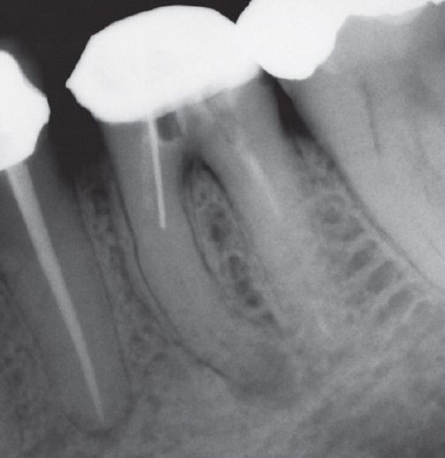 Before Root Canal treatment