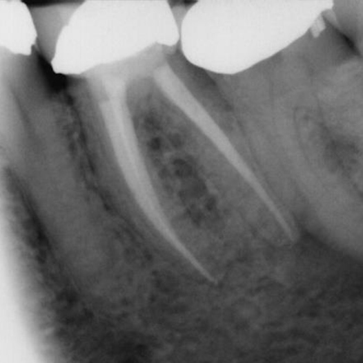 After Root Canal treatment