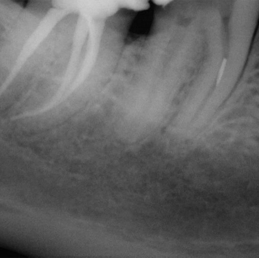 Before Root Canal treatment