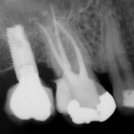 After Root Canal treatment