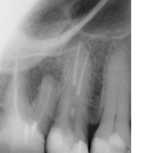After Root Canal treatment