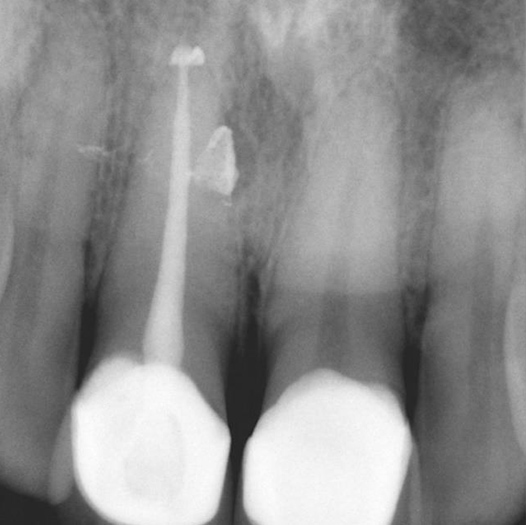 After Root Canal treatment