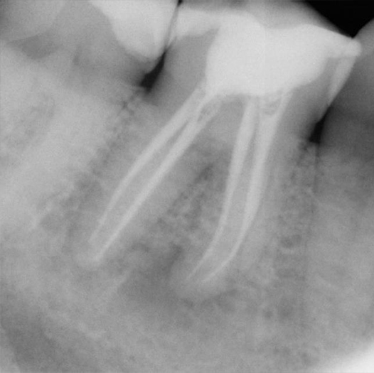 Before Root Canal treatment