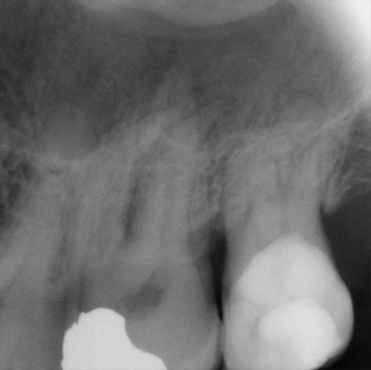 Before Root Canal treatment
