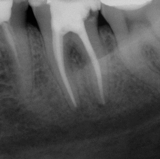 After Root Canal treatment