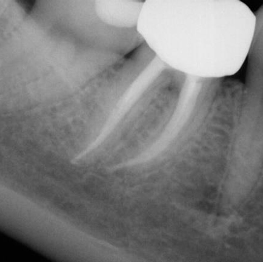 After Root Canal treatment