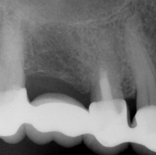 Before Root Canal treatment