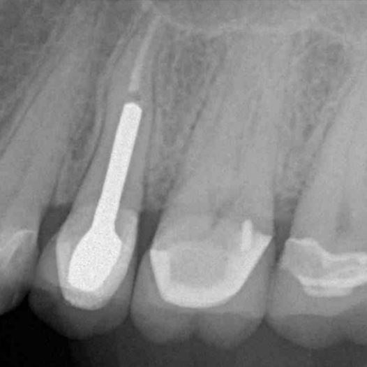 Before Root Canal treatment