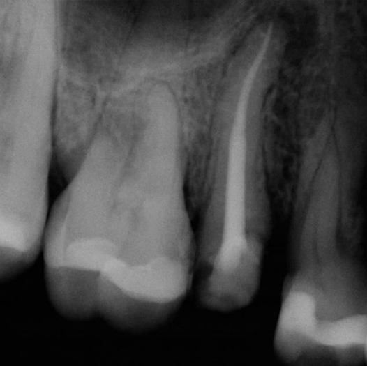 After Root Canal treatment