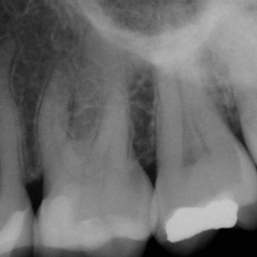 Before Root Canal treatment