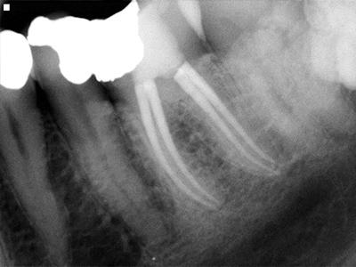 Root canal example